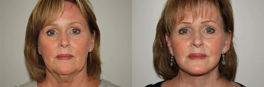 Real patient results in Newport Beach, CA Performed by Boris M. Ackerman MD