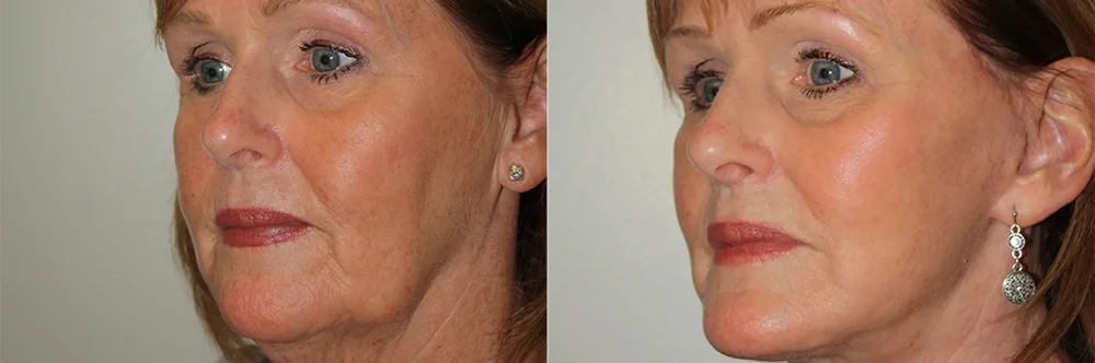 Real patient results in Newport Beach, CA Performed by Boris M. Ackerman MD