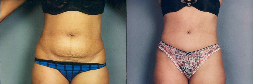 Real patient results in Newport Beach, CA Performed by Boris M. Ackerman MD