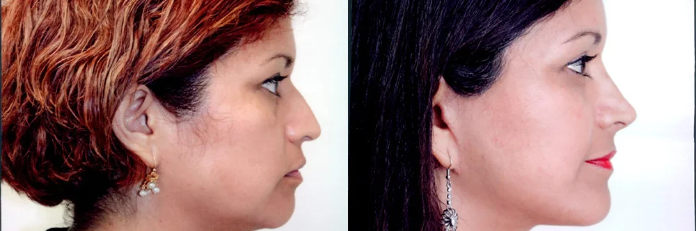 Real patient results in Newport Beach, CA Performed by Boris M. Ackerman MD
