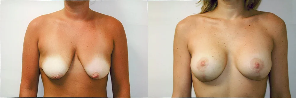 Real patient results in Newport Beach, CA Performed by Boris M. Ackerman MD