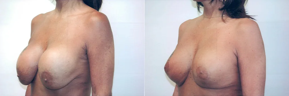 Real patient results in Newport Beach, CA Performed by Boris M. Ackerman MD
