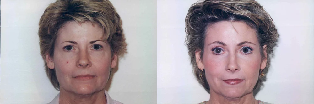Real patient results in Newport Beach, CA Performed by Boris M. Ackerman MD
