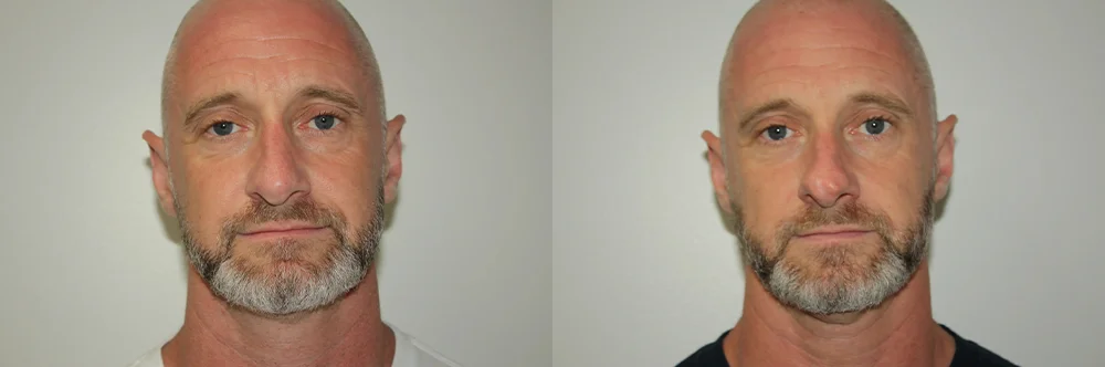 Real patient results in Newport Beach, CA Performed by Boris M. Ackerman MD