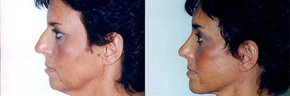 Real patient results in Newport Beach, CA Performed by Boris M. Ackerman MD