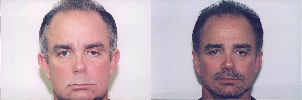 Real patient results in Newport Beach, CA Performed by Boris M. Ackerman MD