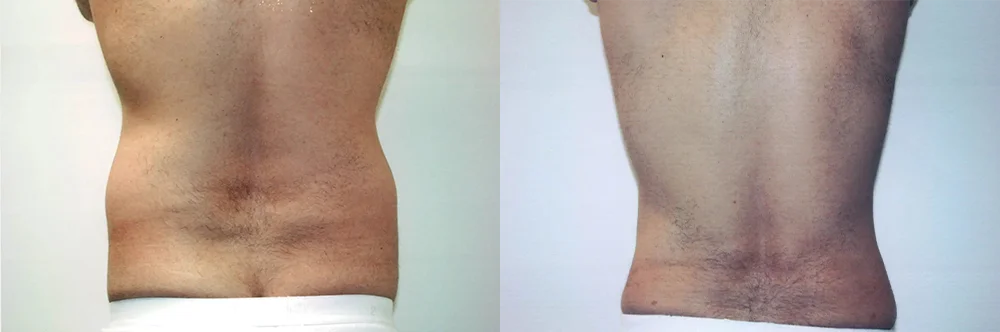 Real patient results in Newport Beach, CA Performed by Boris M. Ackerman MD