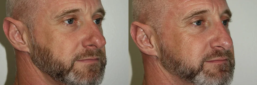 Real patient results in Newport Beach, CA Performed by Boris M. Ackerman MD