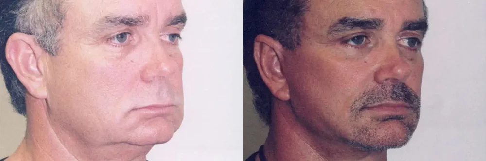 Real patient results in Newport Beach, CA Performed by Boris M. Ackerman MD