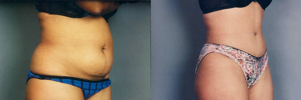 Real patient results in Newport Beach, CA Performed by Boris M. Ackerman MD