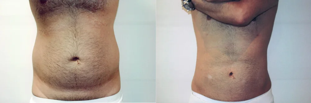 Real patient results in Newport Beach, CA Performed by Boris M. Ackerman MD