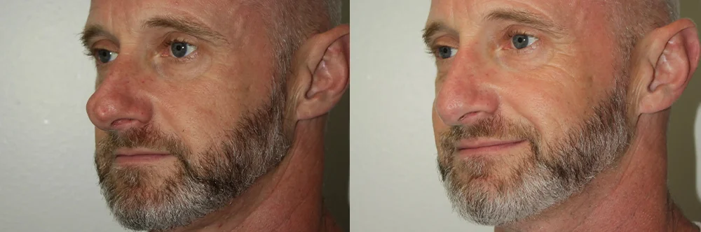Real patient results in Newport Beach, CA Performed by Boris M. Ackerman MD