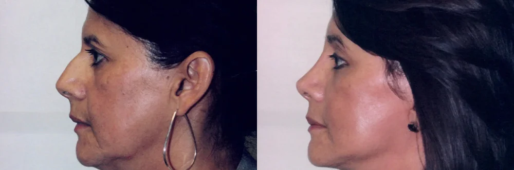 Real patient results in Newport Beach, CA Performed by Boris M. Ackerman MD