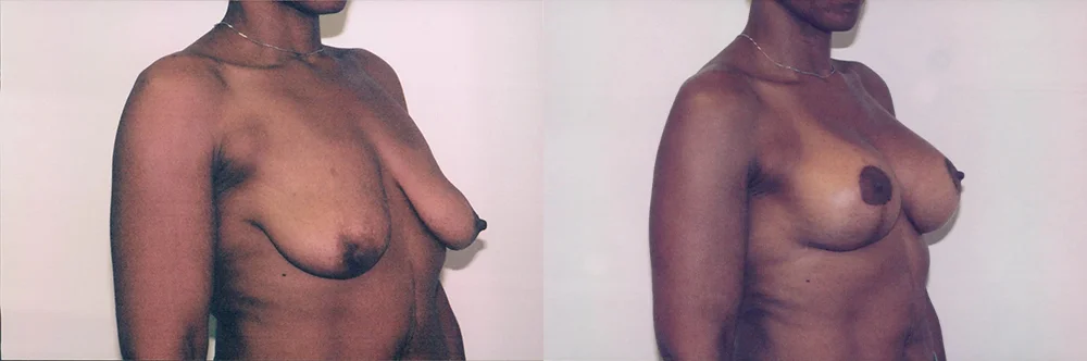 Real patient results in Newport Beach, CA Performed by Boris M. Ackerman MD