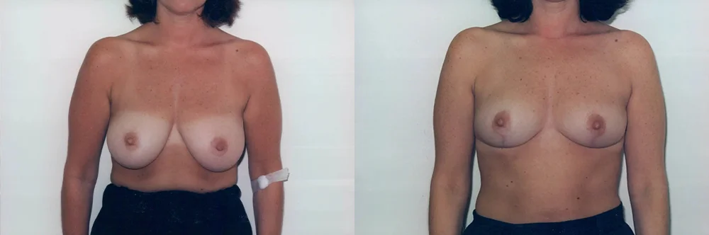 Real patient results in Newport Beach, CA Performed by Boris M. Ackerman MD