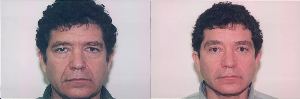 Real patient results in Newport Beach, CA Performed by Boris M. Ackerman MD
