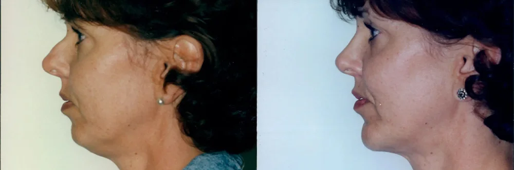 Real patient results in Newport Beach, CA Performed by Boris M. Ackerman MD