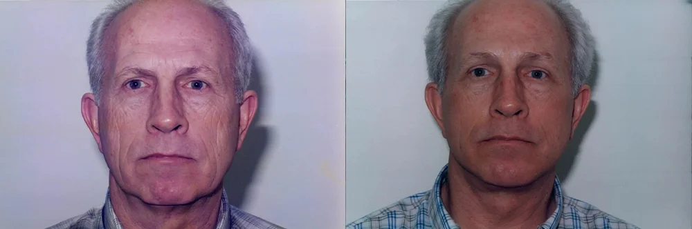 Real patient results in Newport Beach, CA Performed by Boris M. Ackerman MD