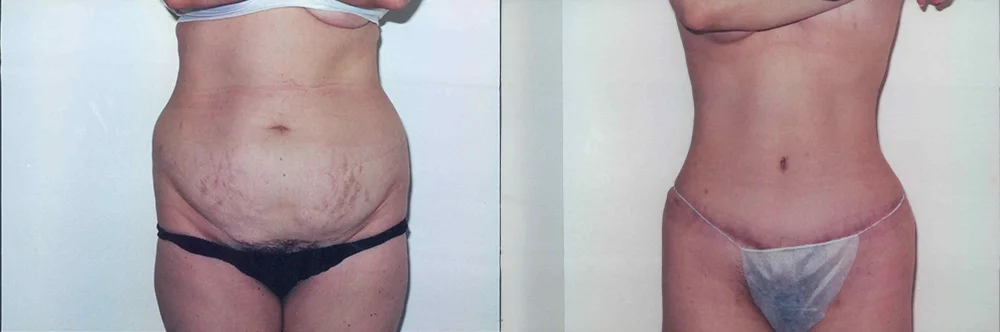 Real patient results in Newport Beach, CA Performed by Boris M. Ackerman MD
