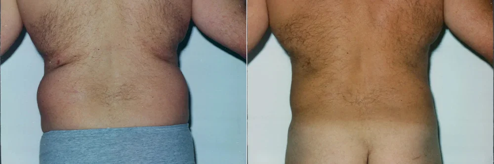 Real patient results in Newport Beach, CA Performed by Boris M. Ackerman MD