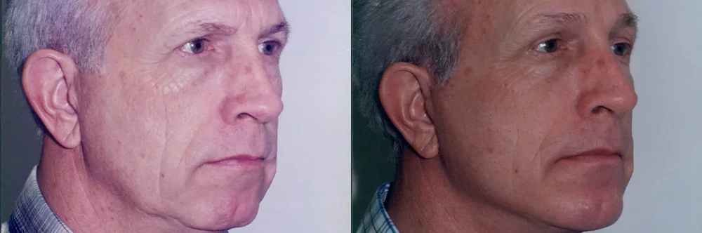 Real patient results in Newport Beach, CA Performed by Boris M. Ackerman MD