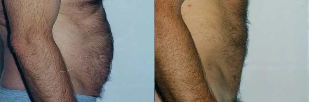 Real patient results in Newport Beach, CA Performed by Boris M. Ackerman MD
