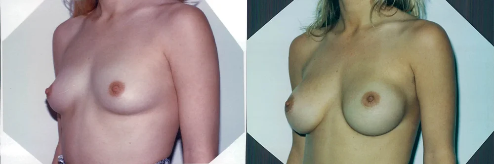 Real patient results in Newport Beach, CA Performed by Boris M. Ackerman MD