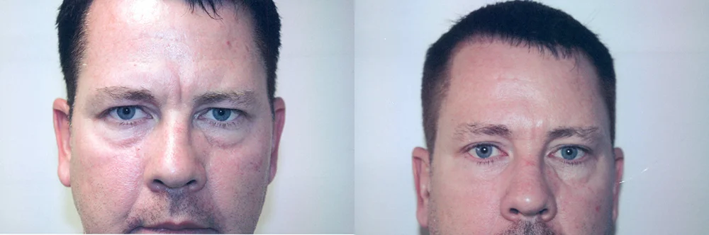 Real patient results in Newport Beach, CA Performed by Boris M. Ackerman MD