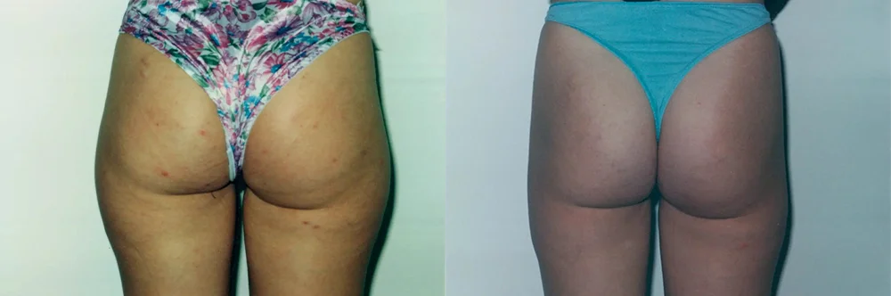 Real patient results in Newport Beach, CA Performed by Boris M. Ackerman MD