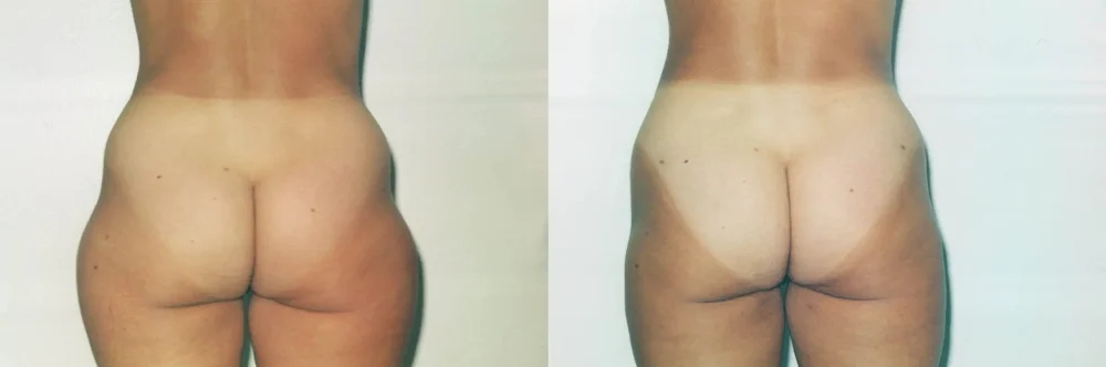 Real patient results in Newport Beach, CA Performed by Boris M. Ackerman MD