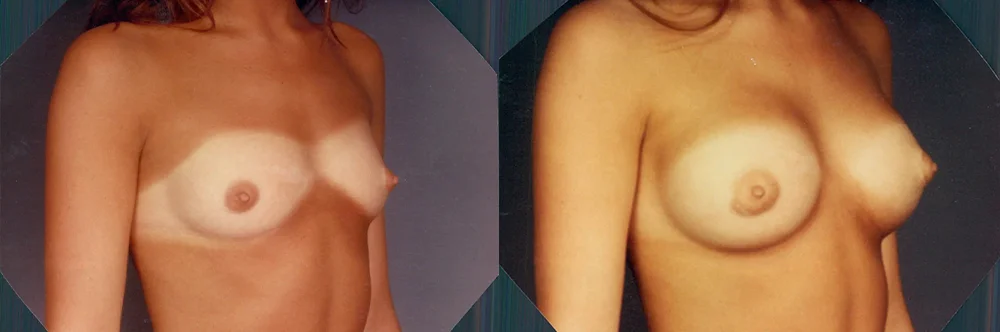 Real patient results in Newport Beach, CA Performed by Boris M. Ackerman MD