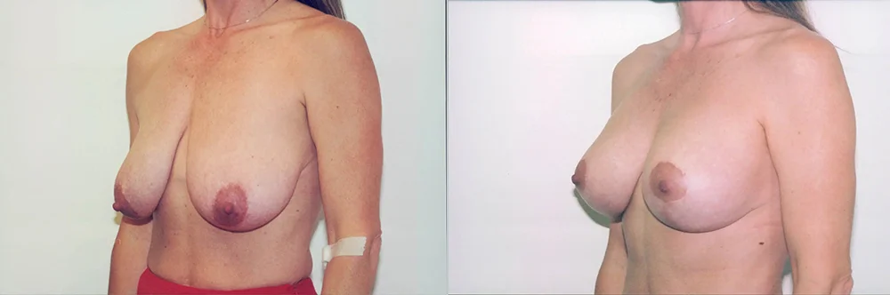 Real patient results in Newport Beach, CA Performed by Boris M. Ackerman MD