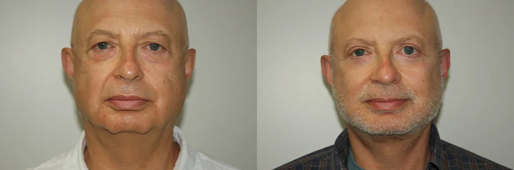 Real patient results in Newport Beach, CA Performed by Boris M. Ackerman MD