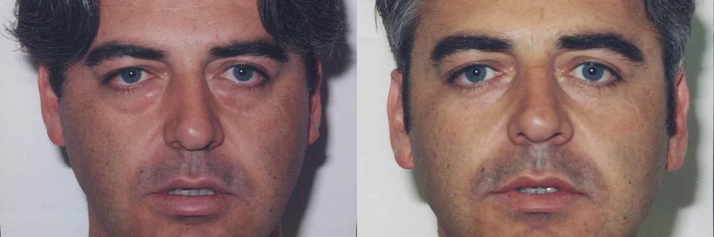 Real patient results in Newport Beach, CA Performed by Boris M. Ackerman MD