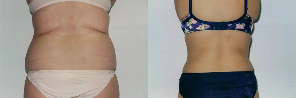 Real patient results in Newport Beach, CA Performed by Boris M. Ackerman MD
