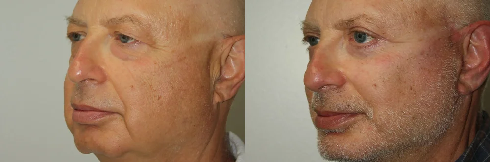 Real patient results in Newport Beach, CA Performed by Boris M. Ackerman MD
