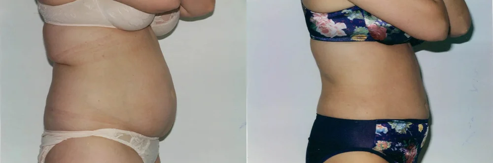 Real patient results in Newport Beach, CA Performed by Boris M. Ackerman MD