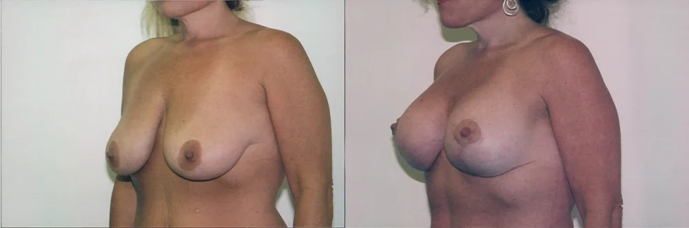 Real patient results in Newport Beach, CA Performed by Boris M. Ackerman MD