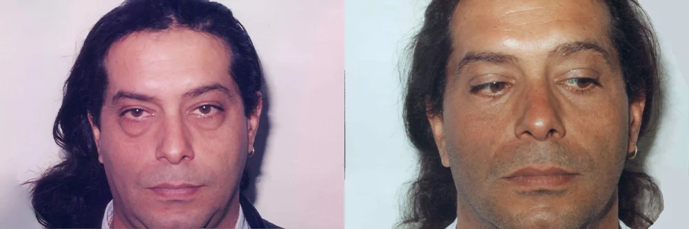 Real patient results in Newport Beach, CA Performed by Boris M. Ackerman MD