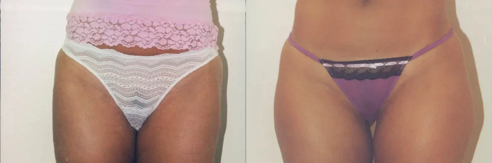 Real patient results in Newport Beach, CA Performed by Boris M. Ackerman MD