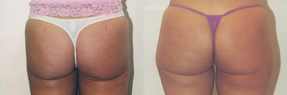 Real patient results in Newport Beach, CA Performed by Boris M. Ackerman MD