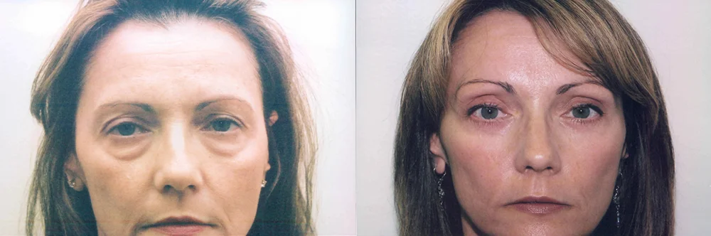 Real patient results in Newport Beach, CA Performed by Boris M. Ackerman MD