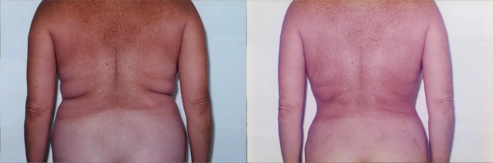 Real patient results in Newport Beach, CA Performed by Boris M. Ackerman MD
