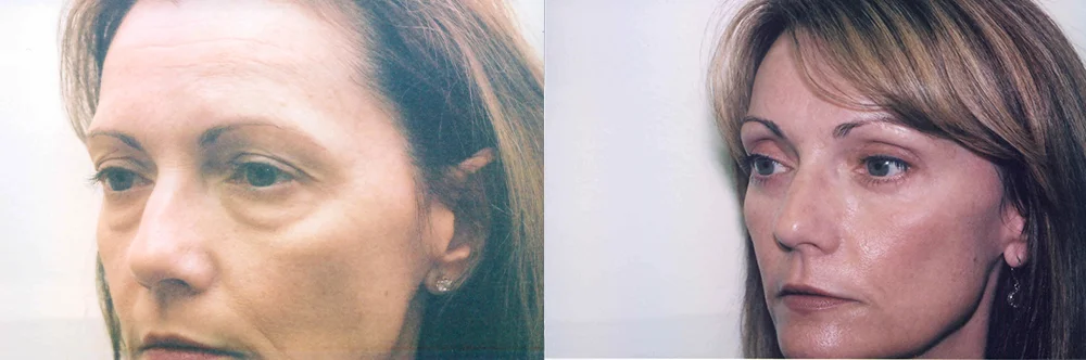 Real patient results in Newport Beach, CA Performed by Boris M. Ackerman MD