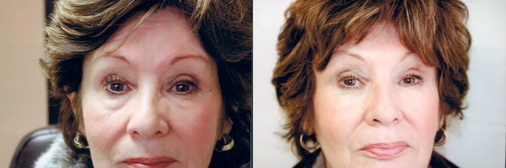 Real patient results in Newport Beach, CA Performed by Boris M. Ackerman MD