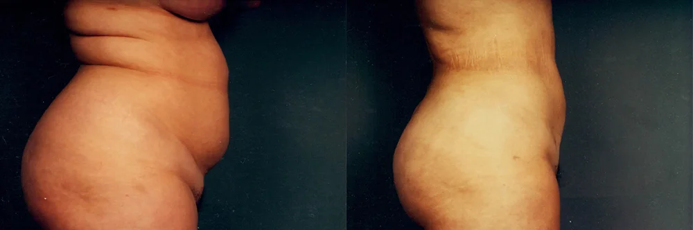 Real patient results in Newport Beach, CA Performed by Boris M. Ackerman MD