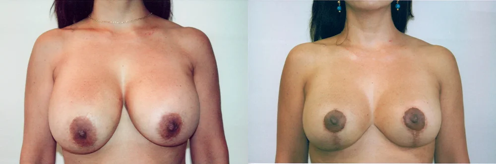 Real patient results in Newport Beach, CA Performed by Boris M. Ackerman MD