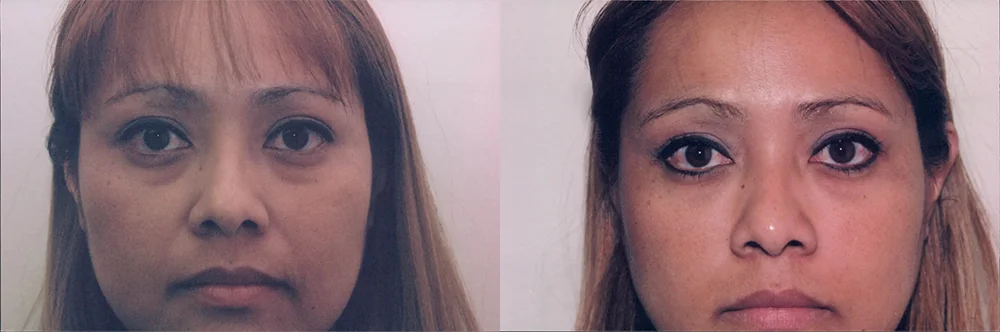 Real patient results in Newport Beach, CA Performed by Boris M. Ackerman MD