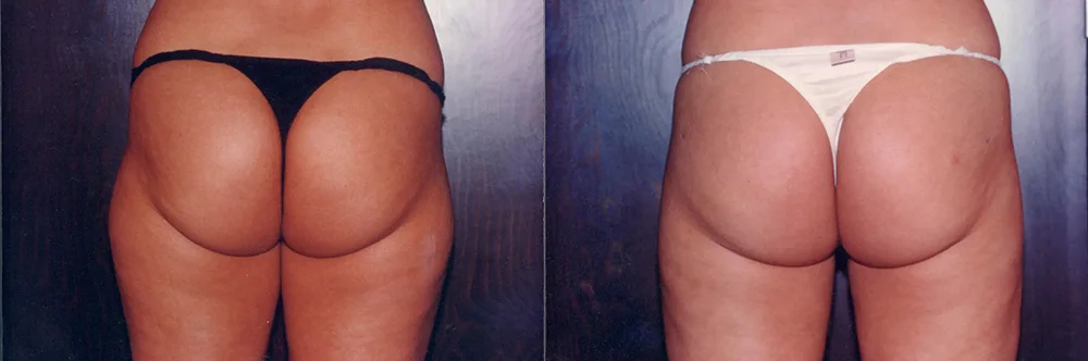 Real patient results in Newport Beach, CA Performed by Boris M. Ackerman MD