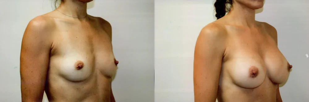 Real patient results in Newport Beach, CA Performed by Boris M. Ackerman MD